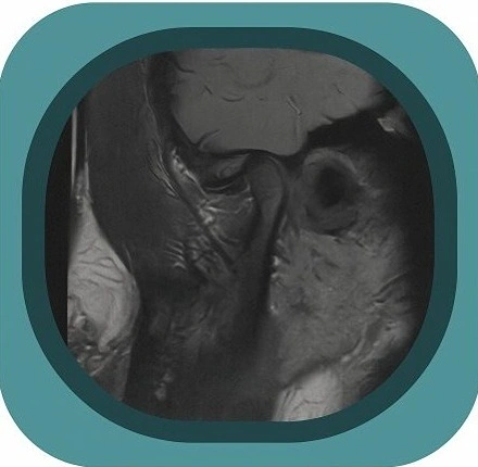 MRI TMJ anatomy icon